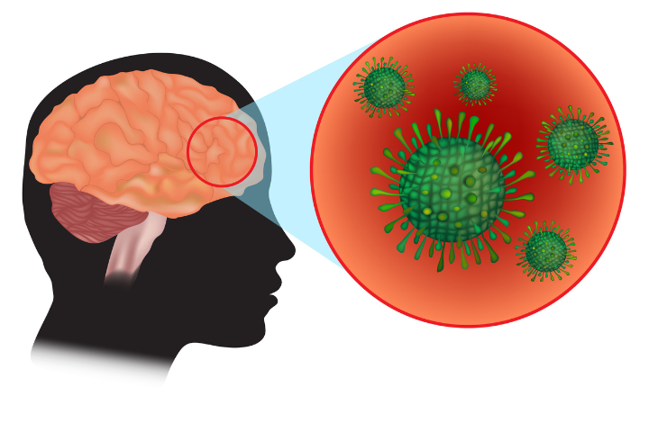 Meningitis